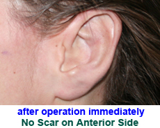 plastic-surgery-prominent-ear 